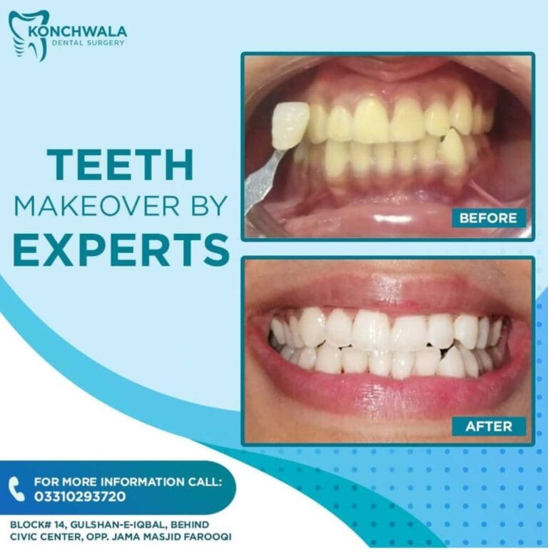 DentistInKarachi | RootCanalInKarachi | DentistNearMeInKarachi | DentalImplantsInKarachi | TeethWhiteningInKarachi | OrthodontistInKarachi | DentalClinicNearMeInKarachi | VeneersInKarachi | WisdomTeethRemovalInKarachi | BestDentistNearMeInKarachi | TeethAlignersInKarachi | ToothExtractionInKarachi | ToothacheInKarachi | DentalHygienistInKarachi | DentalSpecialistInKarachi | FamilyDentistInKarachi