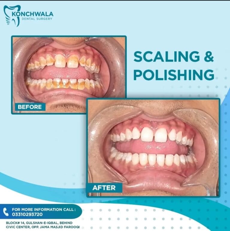 DentistInKarachi | RootCanalInKarachi | DentistNearMeInKarachi | DentalImplantsInKarachi | TeethWhiteningInKarachi | OrthodontistInKarachi | DentalClinicNearMeInKarachi | VeneersInKarachi | WisdomTeethRemovalInKarachi | BestDentistNearMeInKarachi | TeethAlignersInKarachi | ToothExtractionInKarachi | ToothacheInKarachi | DentalHygienistInKarachi | DentalSpecialistInKarachi | FamilyDentistInKarachi