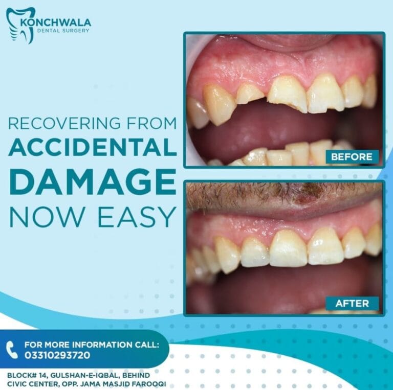 DentistInKarachi | RootCanalInKarachi | DentistNearMeInKarachi | DentalImplantsInKarachi | TeethWhiteningInKarachi | OrthodontistInKarachi | DentalClinicNearMeInKarachi | VeneersInKarachi | WisdomTeethRemovalInKarachi | BestDentistNearMeInKarachi | TeethAlignersInKarachi | ToothExtractionInKarachi | ToothacheInKarachi | DentalHygienistInKarachi | DentalSpecialistInKarachi | FamilyDentistInKarachi